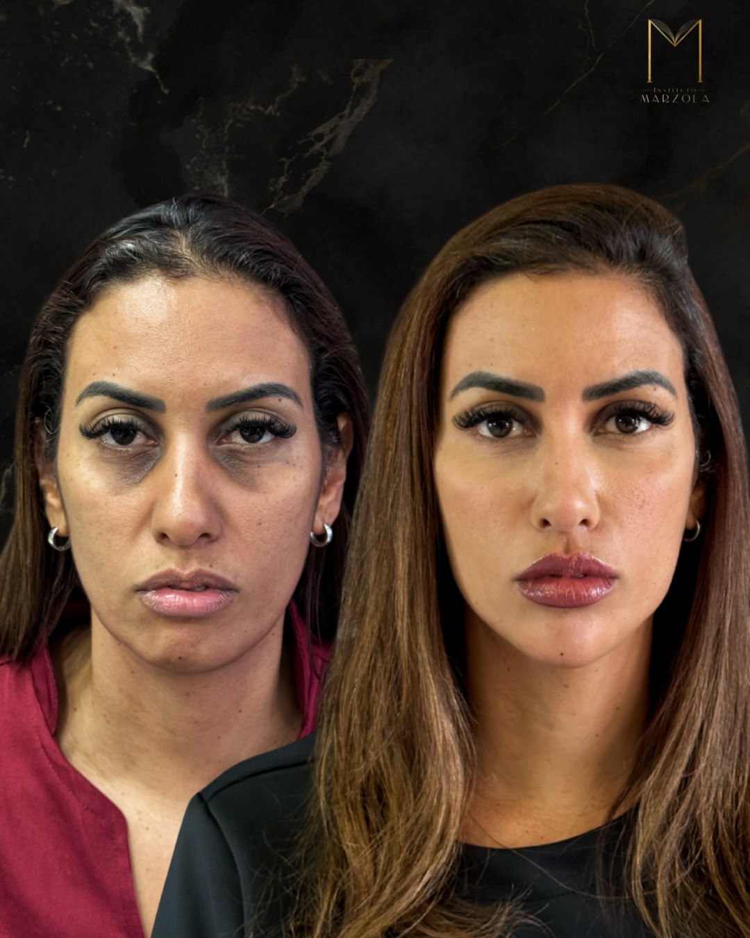 Harmoniza&ccedil;&atilde;o full face — antes e depois, caso real do Instituto